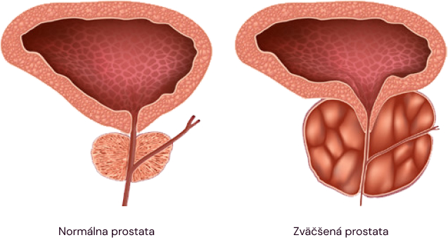 Pri benígnom (nezhubnom) zväčšení prostaty môžu vzniknúť nasledujúce príznaky: